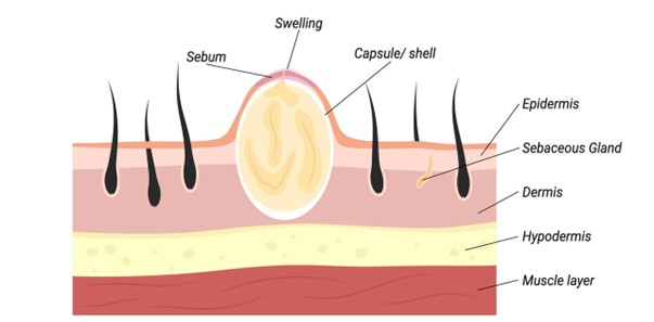 Bướu bã đậu là gì? Triệu chứng, nguyên nhân, chẩn đoán và điều trị bệnh 1