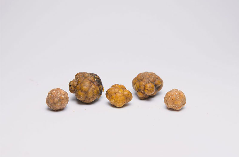 Các loại sỏi đường mật và những điều cần biết 1