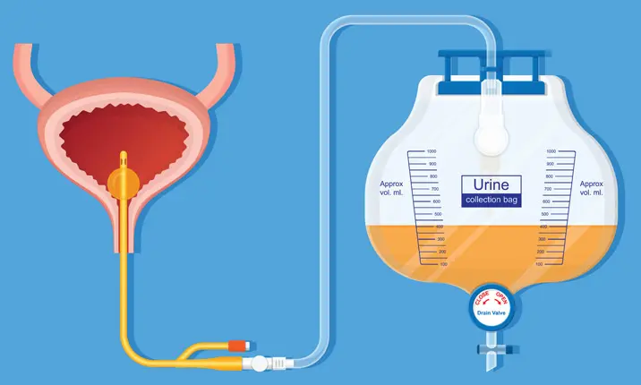 Các phương pháp điều trị trong phẫu thuật ung thư tuyến tiền liệt 3