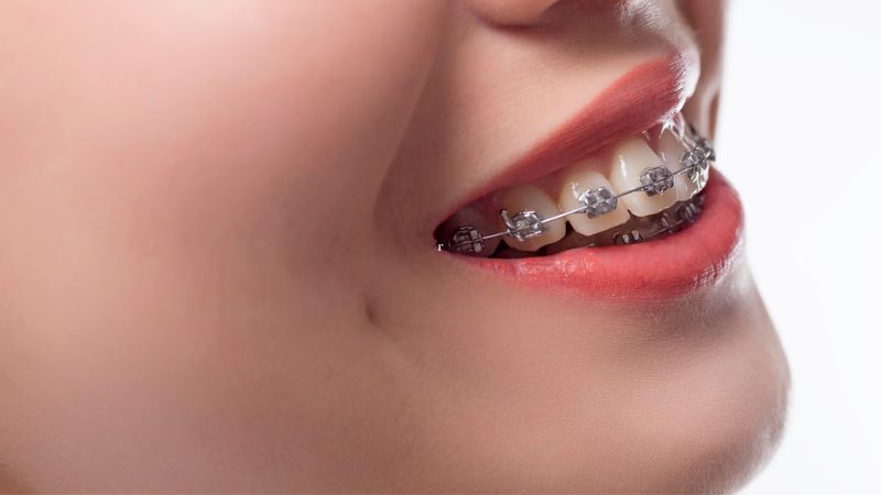 Cách khắc phục tình trạng bị hô 4 răng cửa 4