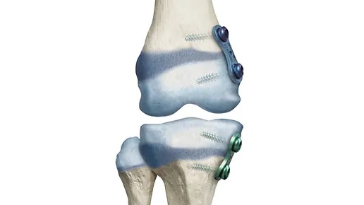 Phẫu thuật tăng trưởng theo hướng dẫn cho tật chân chữ X 4