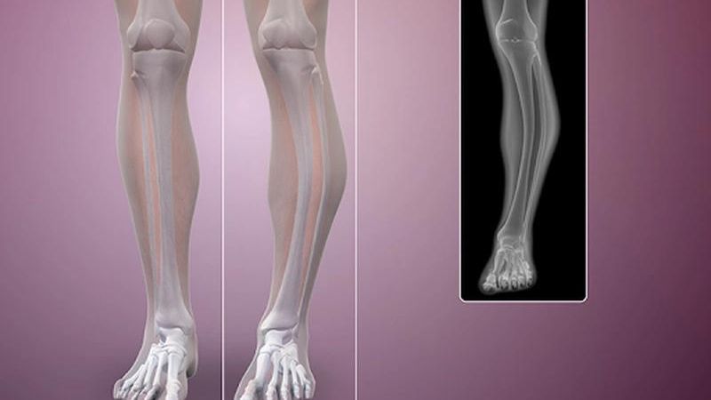 Chẩn đoán u xương ác tính nhờ sinh thiết xương dưới cắt lớp vi tính 1