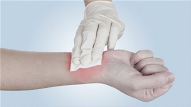 chay-mau-mao-mach-co-dac-diem-gi 3.jpg