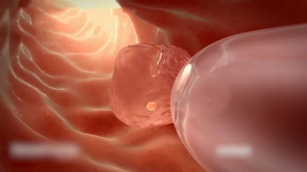 Chuyển phôi ngày 3 tỷ lệ thành công cao không? 1