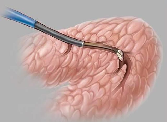 Có mấy loại tuyến nước bọt? Làm gì khi bị viêm tuyến nước bọt? 4