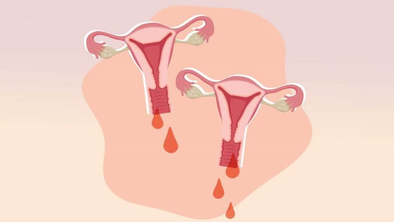 Đặc điểm từng giai đoạn của ung thư cổ tử cung 3