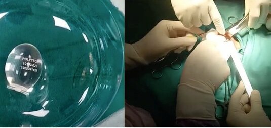 Đặt tinh hoàn nhân tạo có an toàn không? 3