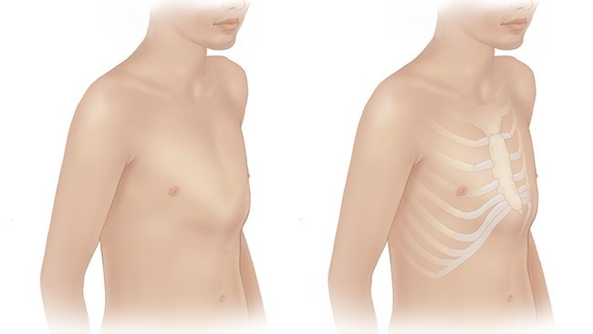 Dị tật xương ức gà ở trẻ có nguy hiểm không? Biện pháp phòng ngừa dị tật xương ức gà ở trẻ em 3