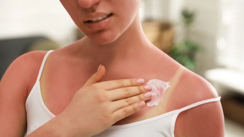 Điều gì sẽ xảy ra nếu bạn bị cháy nắng nhiều lần? 1