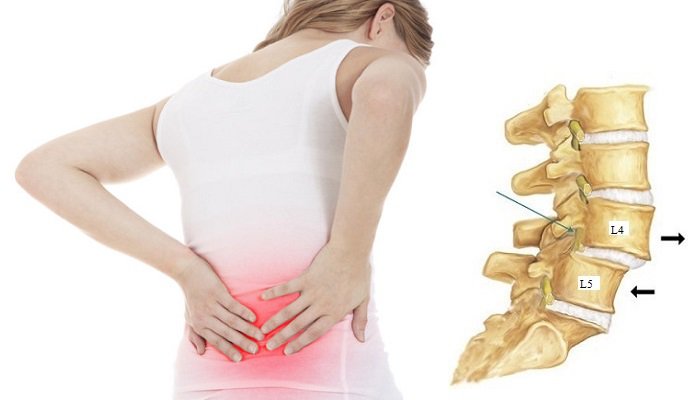 Giải đáp: Đau dây thần kinh hông to là gì? Có nguy hiểm không? 4