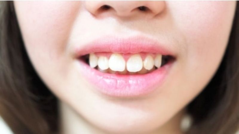 Giải đáp: Tình trạng răng hô nặng có hết được không? 1