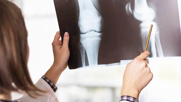 Giải đáp: Vỡ xương bánh chè bao lâu thì đi được? 4