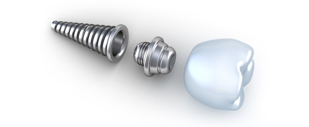 hieu-ro-ve-cau-tao-implant-trong-phuc-hoi-rang 2.jpg