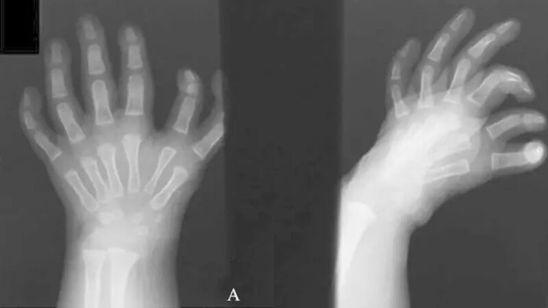 Hội chứng bàn tay gương là gì? Hội chứng này có di truyền không? 3