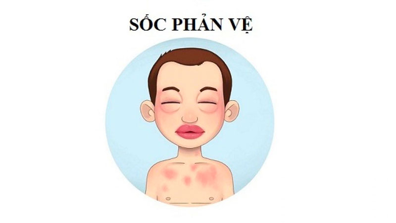 Hộp thuốc chống sốc gồm những gì? 2