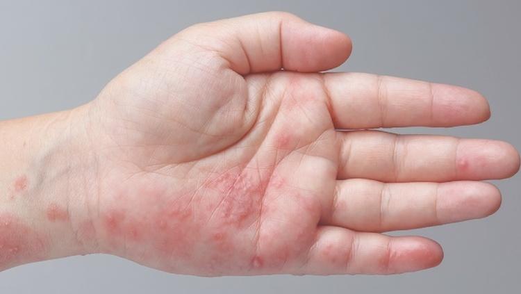 Cách điều trị bệnh ghẻ nước hiệu quả bằng lá trầu không? 2