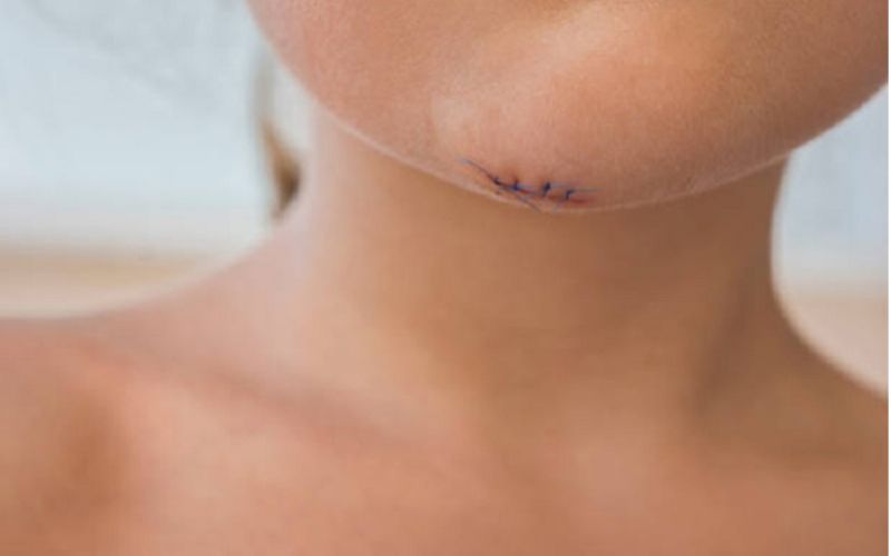 Khâu thẩm mỹ có để lại sẹo không? Điều trị sẹo sao cho hiệu quả nhất? 2