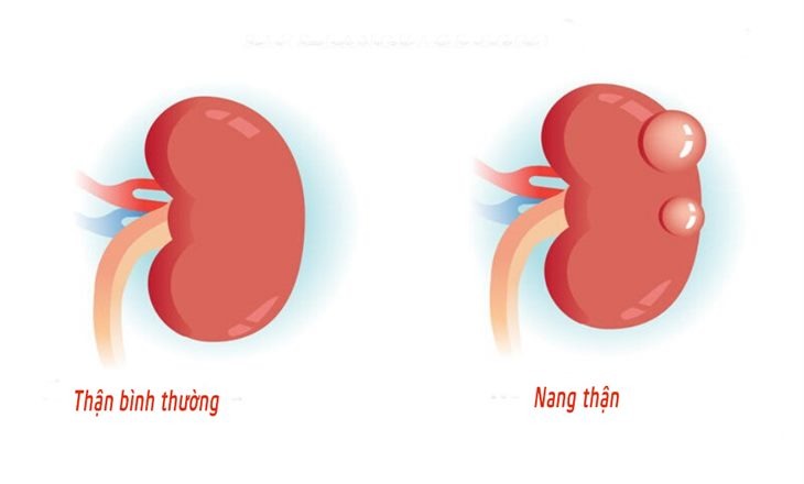 Kích thước nang thận to bao nhiêu thì phải mổ? 2