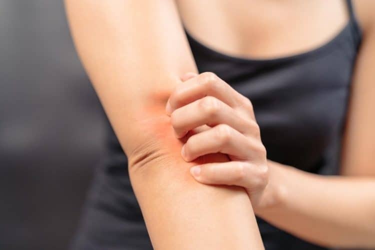 Mẹo chữa bệnh vẩy nến bằng lòng đỏ trứng gà tại nhà 3