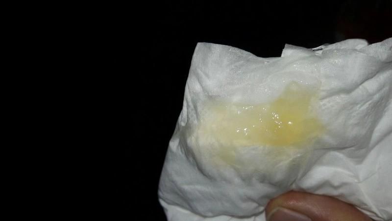 Mucus plug là gì và dấu hiệu bong mucus plug 1