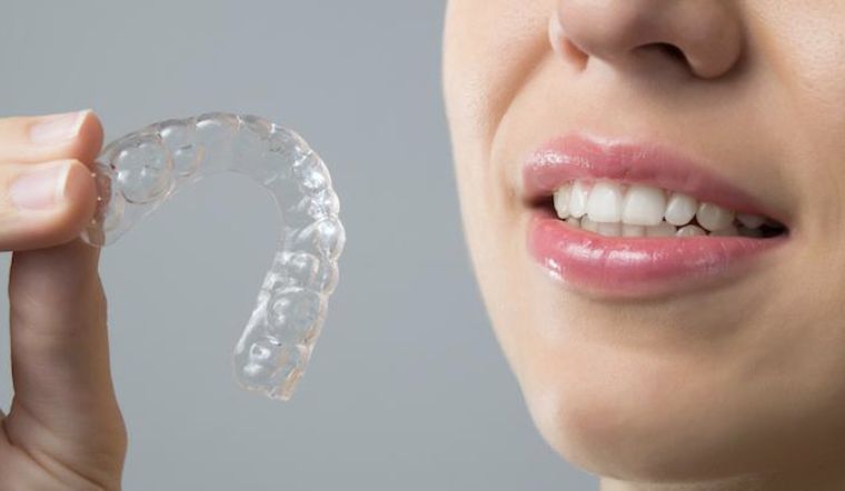 Máng ngậm tẩy trắng răng là gì? Kinh nghiệm ngậm máng tẩy trắng răng tại nhà 1