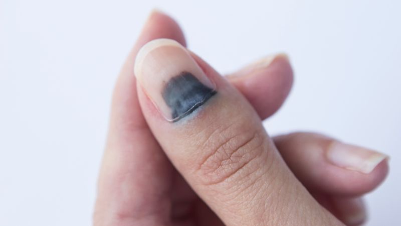 Nguyên nhân móng tay bị tím và cách khắc phục 1