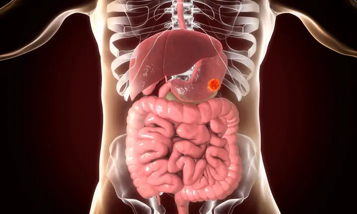 Nguyên nhân tiềm ẩn của ung thư dạ dày 1