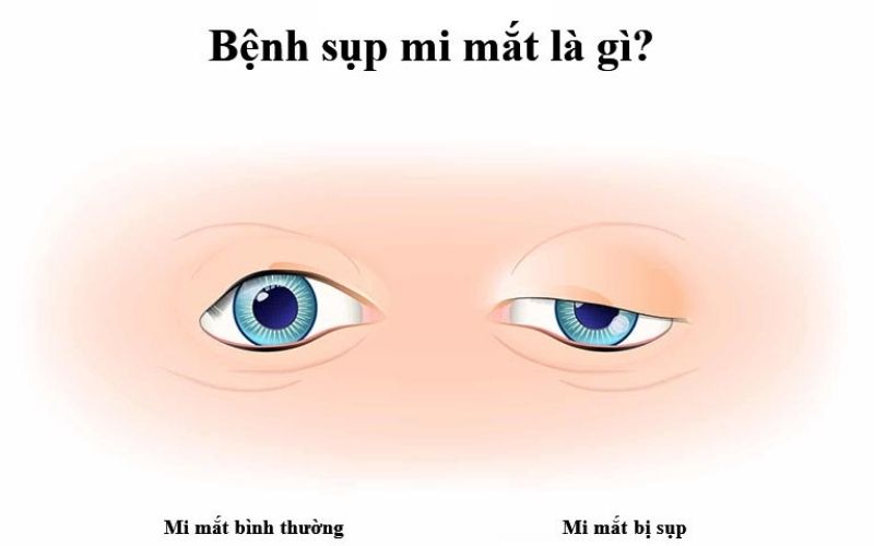 Cách chữa sụp mí mắt bằng Đông y có hiệu quả không? 2