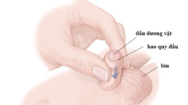 Những điều cần biết về thủ thuật nong bao quy đầu cho bé 1