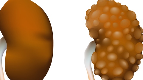 Bệnh thận đa nang bẩm sinh có thể gây thiểu ối 5