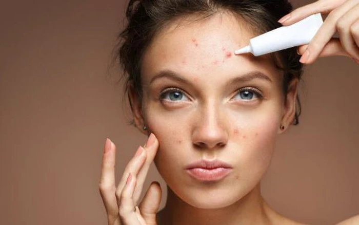 Phác đồ điều trị mụn chuẩn y khoa được Bác sĩ da liễu sử dụng-3