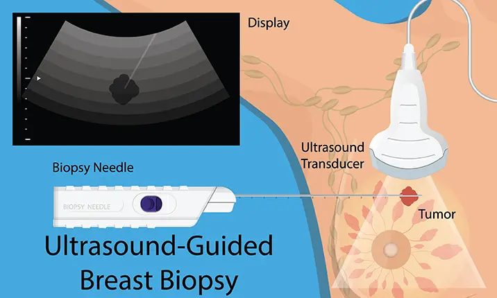 Phẫu thuật xâm lấn tối thiểu và ung thư vú 1
