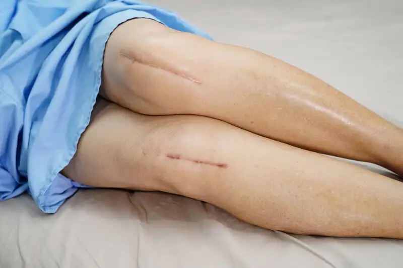 Phục hồi chức năng sau thay khớp gối 4