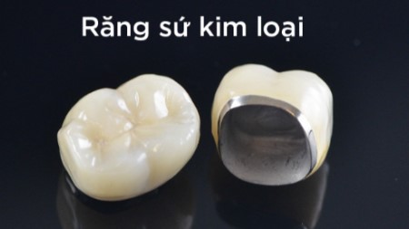 Răng sứ kim loại có mấy loại? Có nên sử dụng răng sứ kim loại không? 1