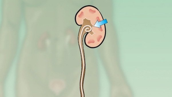 Sonde JJ niệu quản là gì? Rút ống JJ niệu quản có đau không? 4