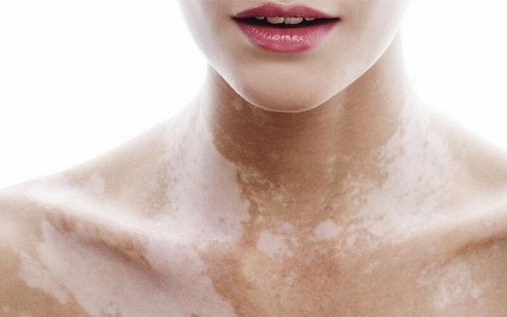 sac-to-da-la-gi-nhung-benh-ly-lien-quan-den-bat-thuong-sac-to-da 2.jpg