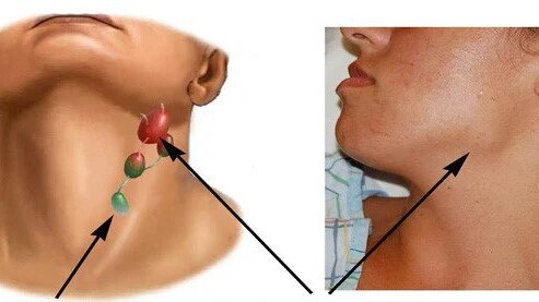 sinh-thiet-hach-va-nhung-dieu-can-biet 1.jpg