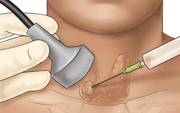 Sinh thiết bằng kim nhỏ có chính xác không? 1