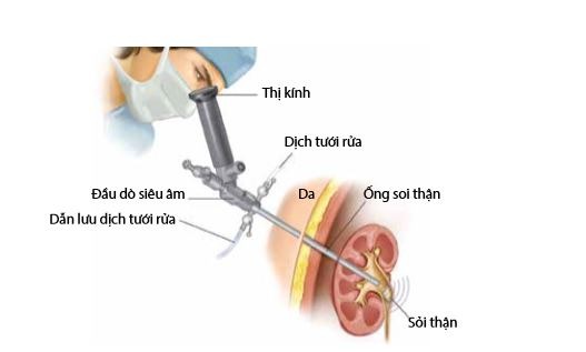 Sỏi thận 5mm có nguy hiểm đến tính mạng không? 2