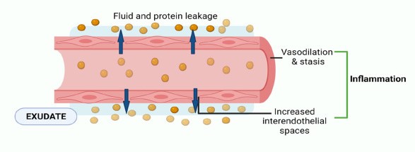 Dịch thấm và dịch tiết khác nhau như thế nào? Cách chẩn đoán phân biệt 2