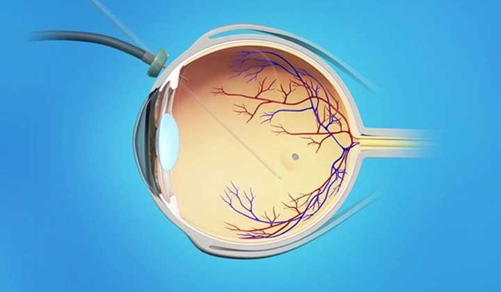 Tăng sinh dịch kính võng mạc có nguy hiểm không? 1