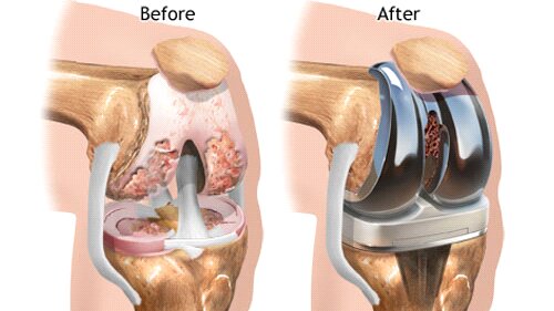 thay-khop-goi-o-benh-vien-nao-tot-nhat 1.jpg