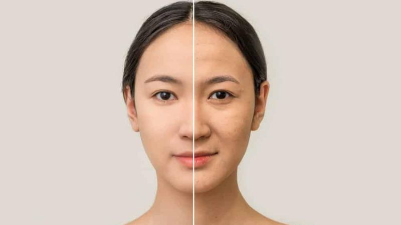 Tìm hiểu cấy collagen tươi giá bao nhiêu và giải pháp thay thế 2