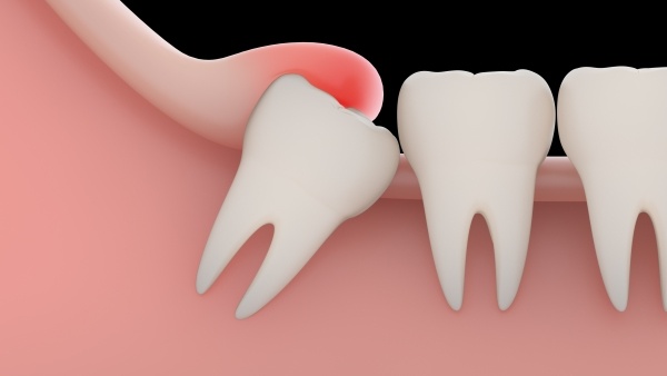 Tình trạng nhổ răng khôn bị sưng diễn ra trong bao lâu? 3