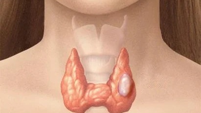 Tirads 5 là gì? Tirads 5 có nguy hiểm không? 1