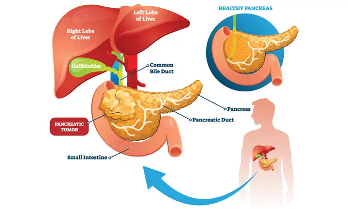 Tổng quan về ung thư tuyến tụy 1