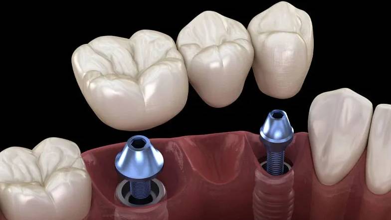 Trám răng sâu lỗ to bao nhiêu tiền? Các yếu tố ảnh hưởng đến chi phí 2