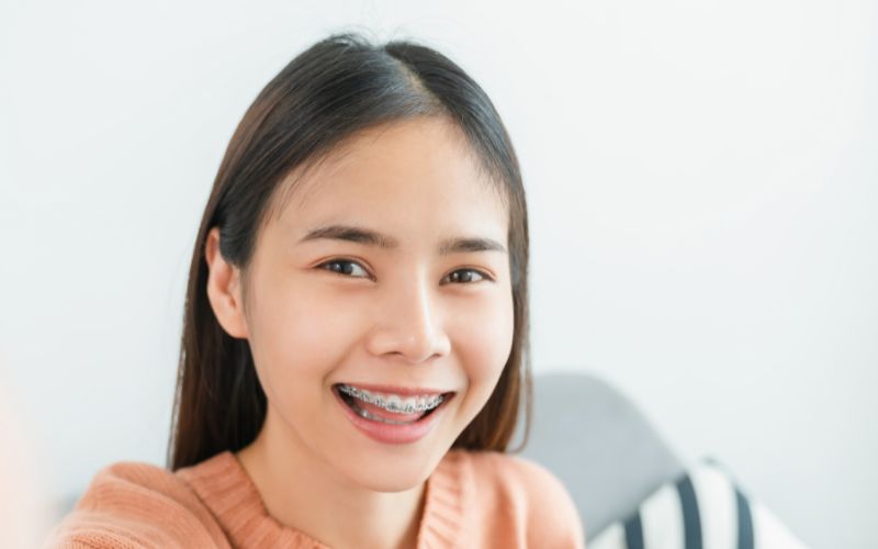 Trẻ 15 tuổi niềng răng bao nhiêu tiền? Niềng răng trong bao lâu? 2