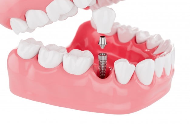 Trồng răng implant Hàn Quốc có tốt không? 1