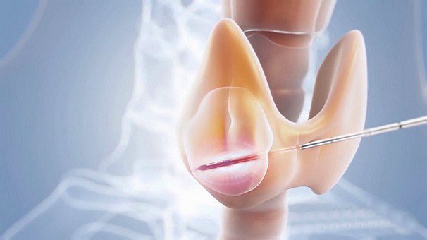 Ung thư tuyến giáp di căn có chữa được không? 1